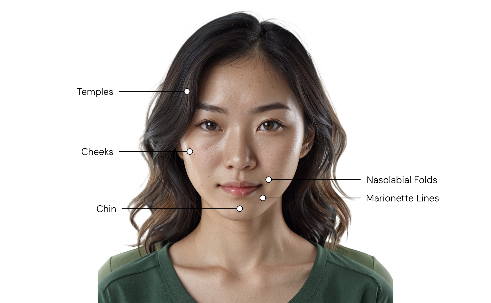 Sculptra treatment diagram